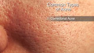 How to Treat Different Types of Acne [upl. by Ynetsed]