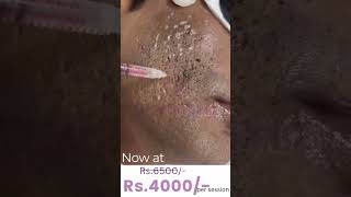 Acne scar Treatment TCA CROSS flawlessskin KrystalskinclinicHyderabad [upl. by Enuj]