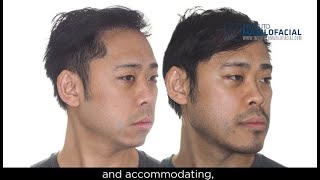 Jaw surgery Case  101 Kendrick  Sleep Apnea Maxillomandibular Retrusion [upl. by Ednew]