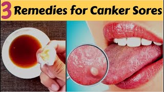 How to Get Rid of Blisters on the Tongue  Home Remedies for Mouth Ulcers [upl. by Heron]