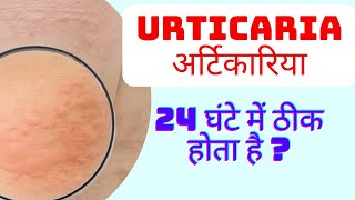 urticaria in hindi  urticaria treatment in hindi  hives on skin  urticaria symptoms [upl. by Gretchen]