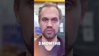 HAIR TRANSPLANT GROWTH PROCESS  12 MONTHS  SMILE HAIR CLINIC [upl. by Paynter]