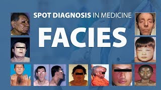 Abnormal Facies  Spot Diagnoses in Medicine [upl. by Allsun320]