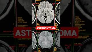 Imaging Tumors  Astrocytoma [upl. by Croix]