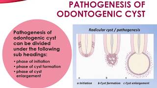 Pathogenesis of Odontogenic Cyst [upl. by Turley]