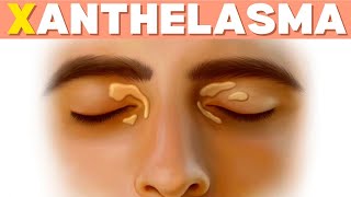 Why Your Skin Care Routine Is Failing Due to Xanthelasma [upl. by Elleynod]