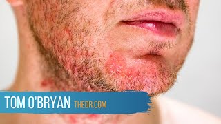 Dermatitis Herpetiformis A GlutenRelated Disorder  Dr Tom OBryan [upl. by Alemak]