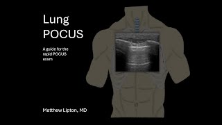 How to perform a POCUS lung exam rapid yet complete [upl. by Lek]