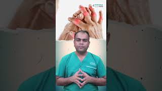 क्रिकेट की चोट उंगली में PIP Joint Fracture Dislocation और उसका इलाज [upl. by Saraiya]