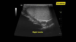 Testicular microlithiasis  Ultrasound Case  GU [upl. by Adama]