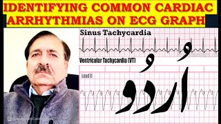 Identifying Common cardiac arrhythmias on ECG graph  Lectures by Dr Alamzeb [upl. by Ahsitnauq]