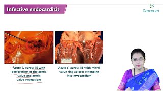 Infective Endocarditis Hindi  Internal Medicine [upl. by Cameron507]