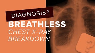 Chest XRay breakdown assessing pericardial calcification [upl. by Weight]