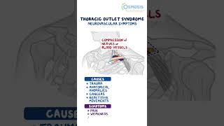 Thoracic Outlet Syndrome [upl. by Sarina21]