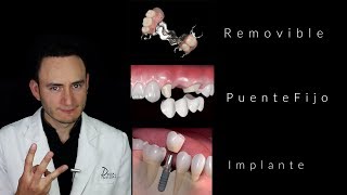 Puentes vs Implantes  ¿Cuál es la mejor opción  Dentista en Querétaro [upl. by Atiuqin]