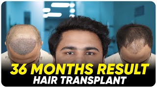 Hair Transplant in Mangalore  Best Results amp Cost of Hair Transplant in Mangalore [upl. by Niamrej]