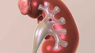 Kidney Stone Treatments [upl. by Aklim592]