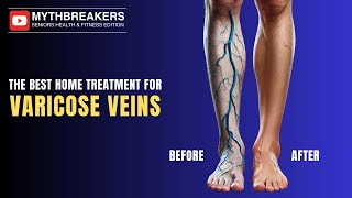 Varicose Veins  All You Need to Know  The Best Home Treatments [upl. by Rossner]