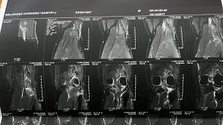 Update Rodilla  Operación ACL amp Meniscus skateboard skateboarding puertorico surgery menisco [upl. by Nnylireg]