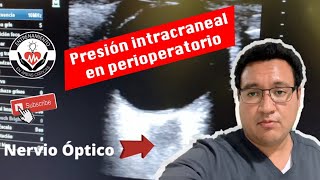 Presión intracraneal por DVNO por USG en perioperatorio [upl. by Aniled100]