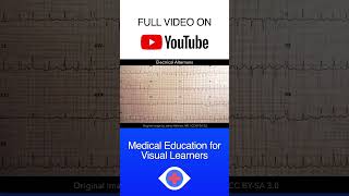 Electrical Alternans ECG shorts [upl. by Riamo243]