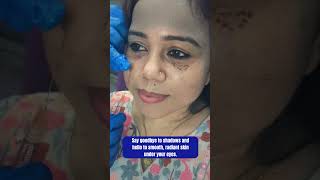 UnderEye Filler Treatment  Skin Clinic  Skin Treatment  Kolkata  youtubereels youtubeshorts [upl. by Auqinat]