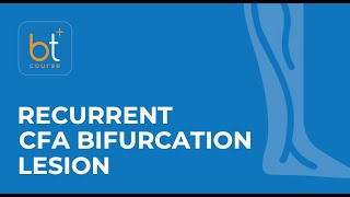 Course Preview Endovascular Treatment of a Recurrent CFA Bifurcation Lesion [upl. by Luther]