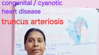 congenital cyanotic heart disease truncus arteriosis class in tamil [upl. by Docile]