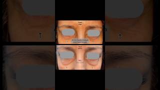 Alt Göz Kapağı Ameliyatı Lower Eyelid Surgery [upl. by Annaeoj]