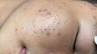 ACNE TREATMENT VU QUYNH MI  Blackheads On Boy Face 2024FULL [upl. by Lydie306]