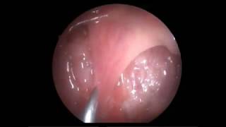 Arête de poisson amygdale droite fishbone stuck in the right tonsil [upl. by Skill]