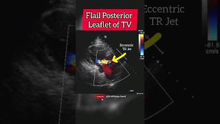 Flail Tricuspid Valve Posterior Leaflet of Heart ♥ echocardiography heart [upl. by Romonda699]