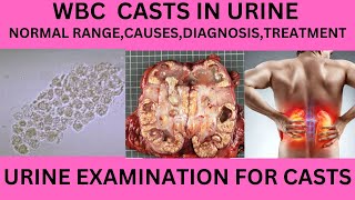 WBC CAST IN THE URINE CAUSES SYMPTOMS AND TREATMENT OF WBC CAST IN URINE EXAMINATIONURINE ROUTINE [upl. by Cayla]