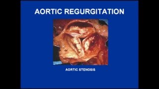 Aortic Stenosis and Regurgitation Variations [upl. by Hulbig]