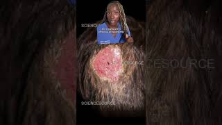 Is Your Scalp Itching Discover the Causes of Scalp Ringworm Tinea Capitis [upl. by Amein]