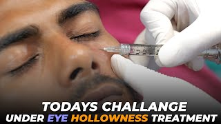 Under Eye Hollowness Treatment  Awish Clinic  Under Eye Filler  undereyedarkcircle viral [upl. by Ahselaf]