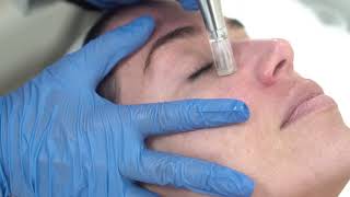 Awaken Eyes  MDPen MicroNeedling [upl. by Ehgit]