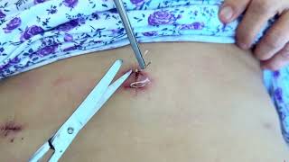 Снятие швов  Suture removing Stitches removal [upl. by Lonier197]