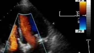 Prosthetic tricuspid valve and mitral valve [upl. by Gnes]