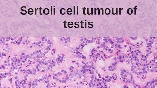 Sertoli Cell Tumour of the Testis  Pathology mini tutorial [upl. by Bridges973]