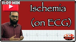 Ischemia ׀ Myocardial Infarction MI ׀ How to diagnose on ECG EKG ׀ dr joos [upl. by Claudio]