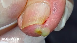 DEDO ENCRAVADO podologomaurelio podiatry satisfying [upl. by Einalam]