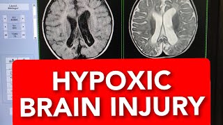 MRI of Hypoxic Ischaemic Brain Injury 10months Child shorts shortsvideo shortsvideos [upl. by Tanah762]