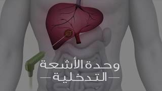 ما هي الأشعة التدخليه؟ علاج بدون جراحة What is Interventional Radiology [upl. by Palestine704]