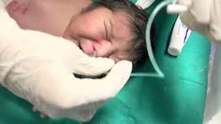 Nasogastric tube NG insertion in a neonate  newborn  orogastric tube  feeding tube [upl. by Anayk868]