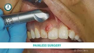 Painless Laser Surgery of Oral Epulis [upl. by Tessler]