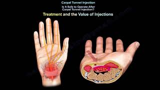 Carpal Tunnel Injection Is injection helpful [upl. by Zeugirdor]