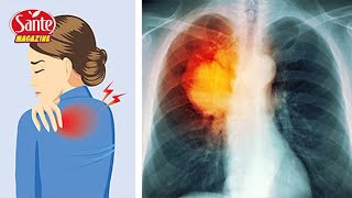 8 signes dalerte précoces du cancer du poumon que toute femme doivent savoir [upl. by Annonyw]