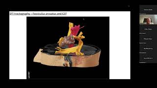 IESSESTM webinar series Global Epilepsy Surgery Technique Rounds [upl. by Aryc553]