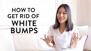 How to Get Rid of the White Bumps on Your Face  Peach amp Lily [upl. by Heath]